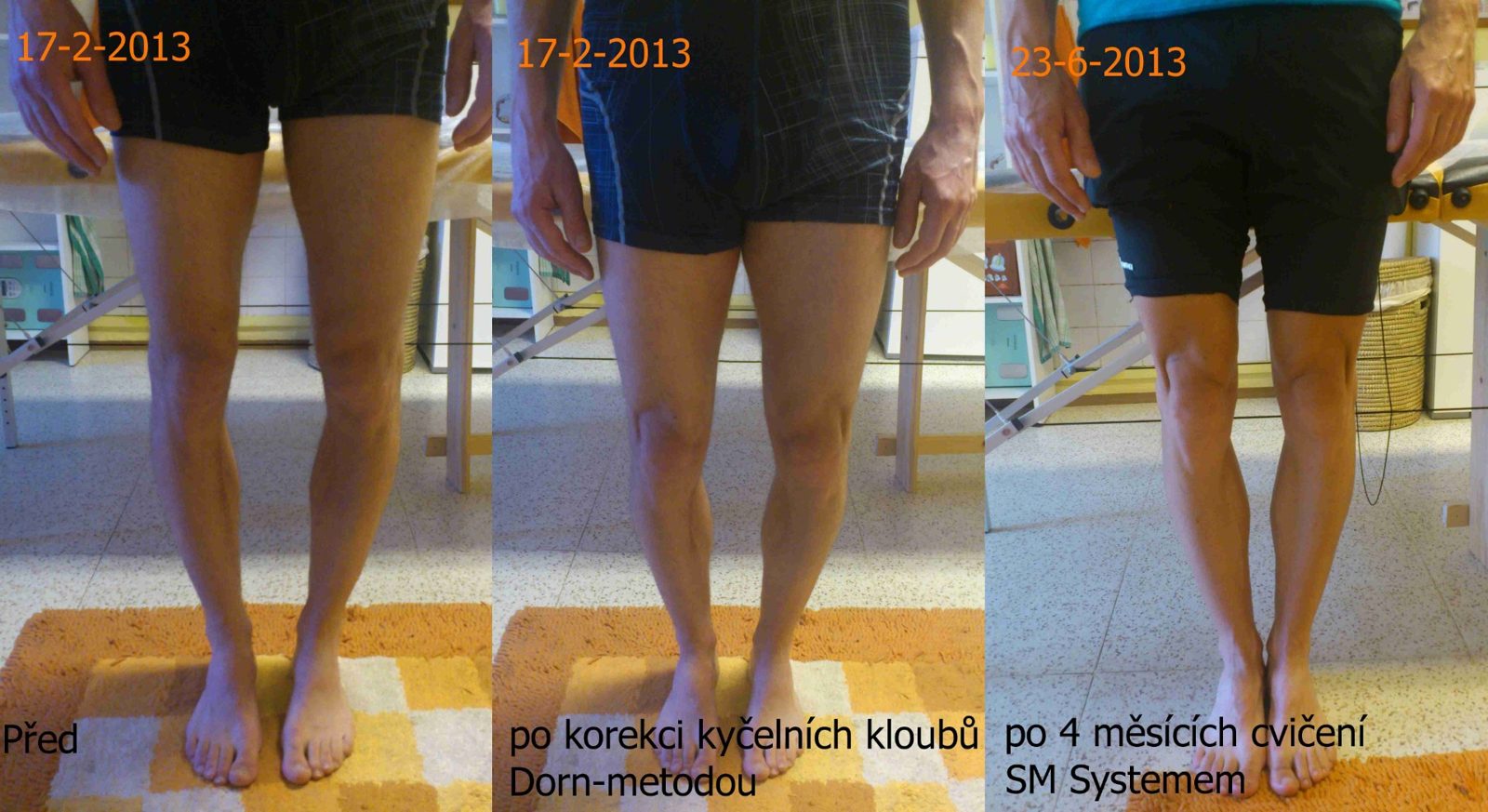 Před, po korekci kyčelních kloubů a po čtyřech měsících cvičení