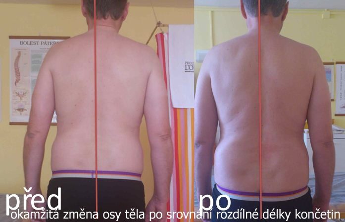 Před a po: okamžitá změna osy těla po srovnání rozdílné délky končetin