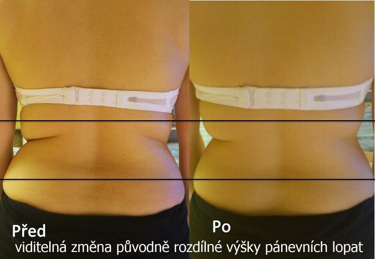 Před a po: srovnání původně rozdílné výšky pánevních lopat