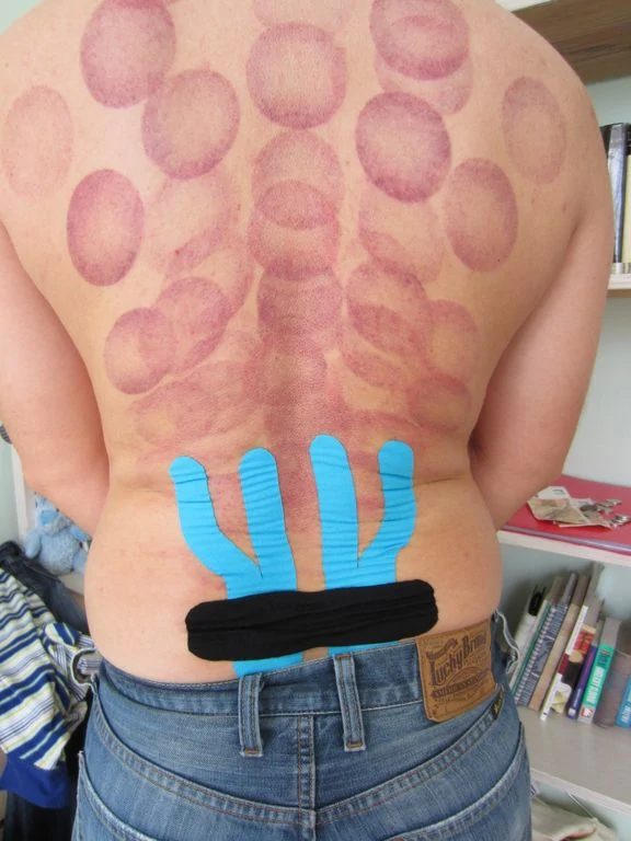 Kineziotape na bederní páteři